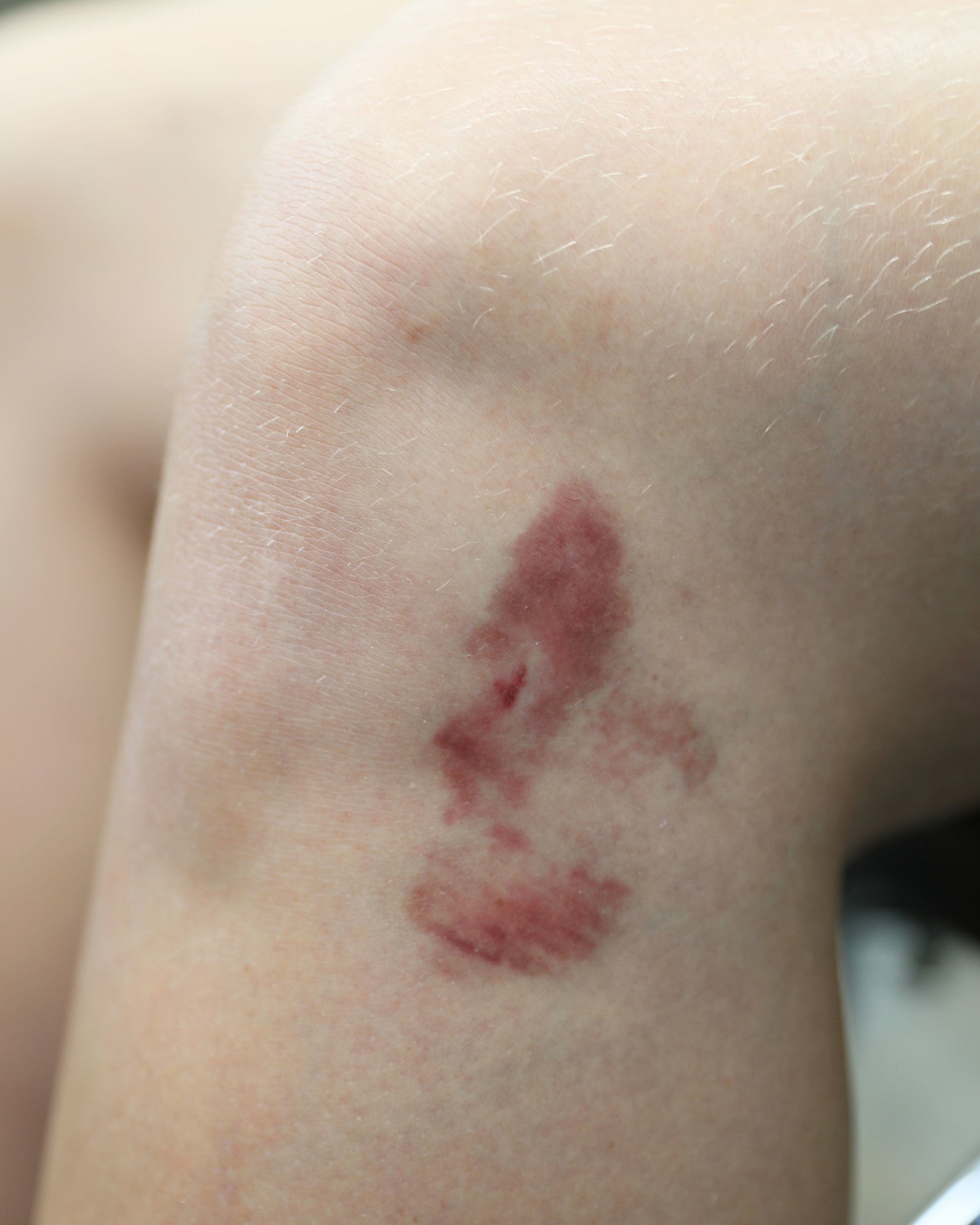 Hematomas 1B - Bruises 1B