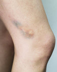 Hematomas 2C - Bruises 2C