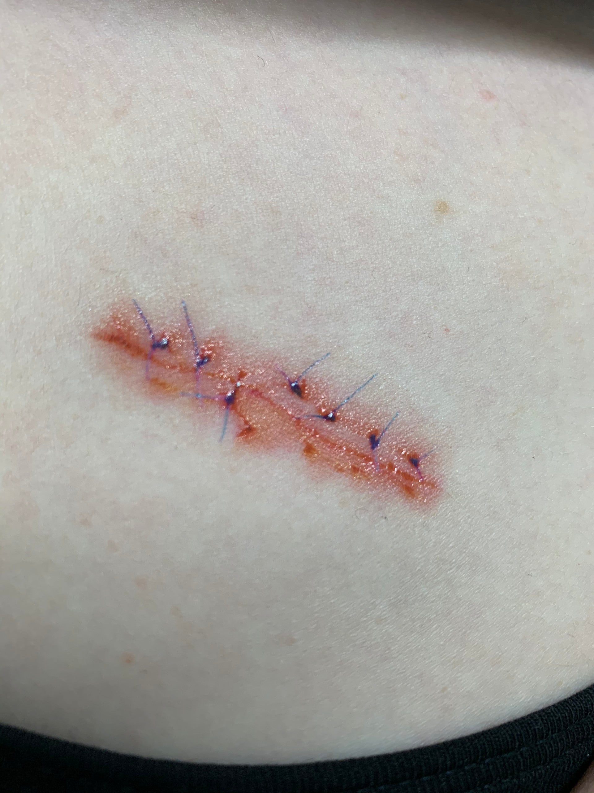 Scars and Sutures A- Scars and Sutures A