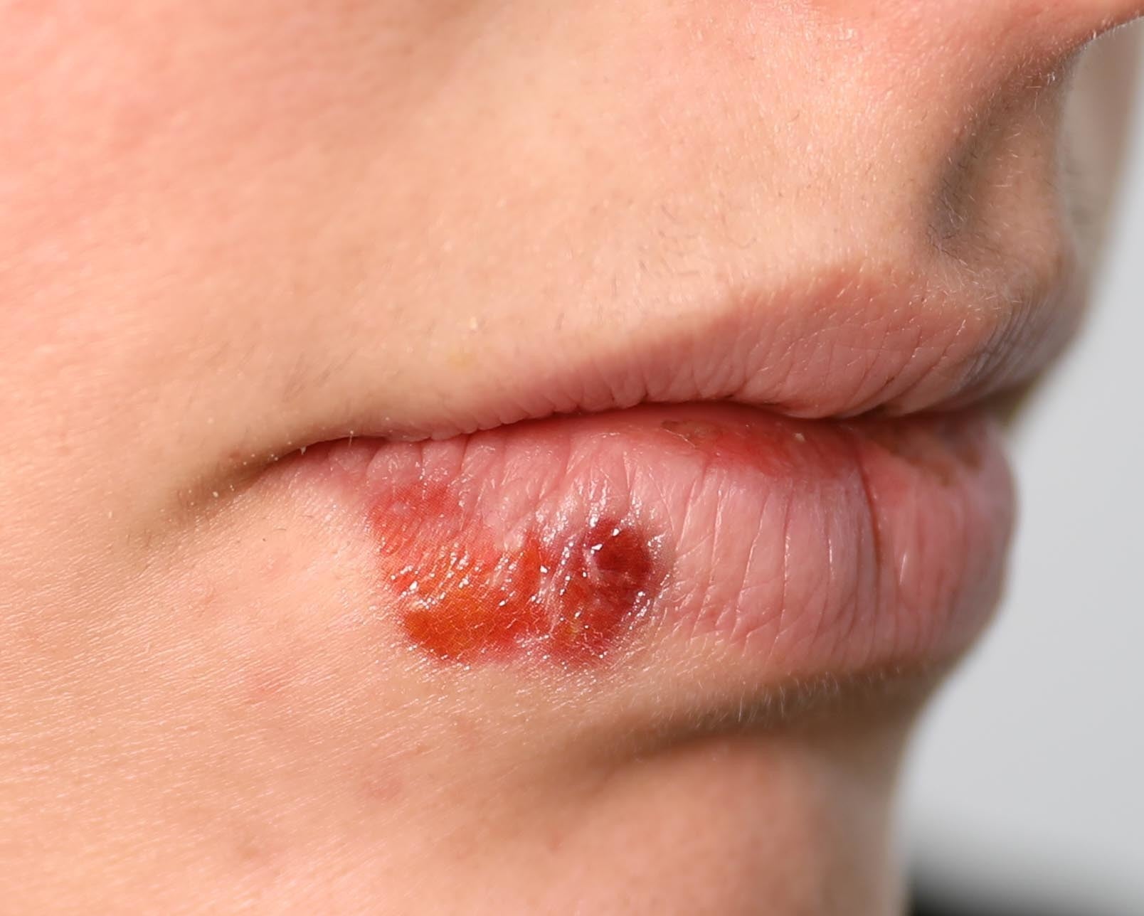 Doencas De Pele Qual Medicamento Posso Passar E Tomo Exemplo